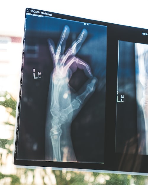 An X-ray of a person's hand making the ok symbol
